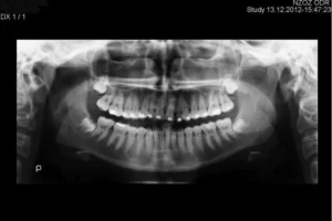 PANTOMOGRAM CYFROWY